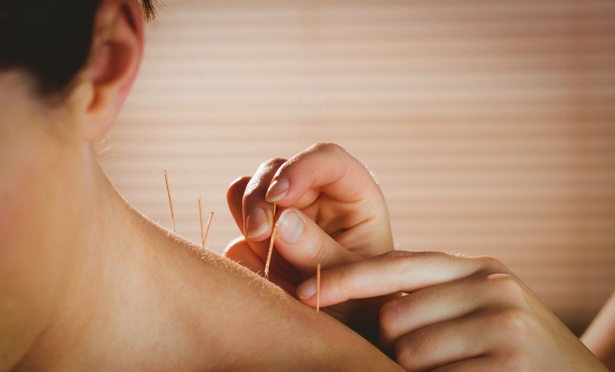 Our about image for Acme Acupuncture.  See more information for our Dorking location.